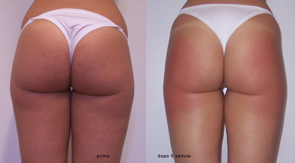 trattamenti per la cellulite