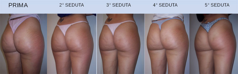 ultrasuoni per cellulite