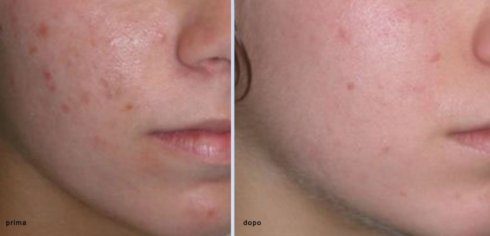 Terapia FotoDinamica Modulata per la cura dell'ACNE